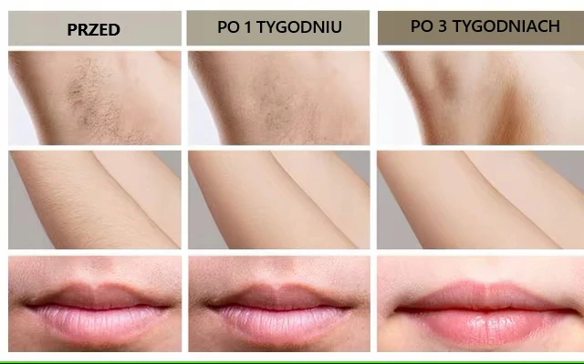 Depilator IceCool IPL Pro – 1MLN Błysków | 5 Trybów | Twarz Ciało Bikini 3